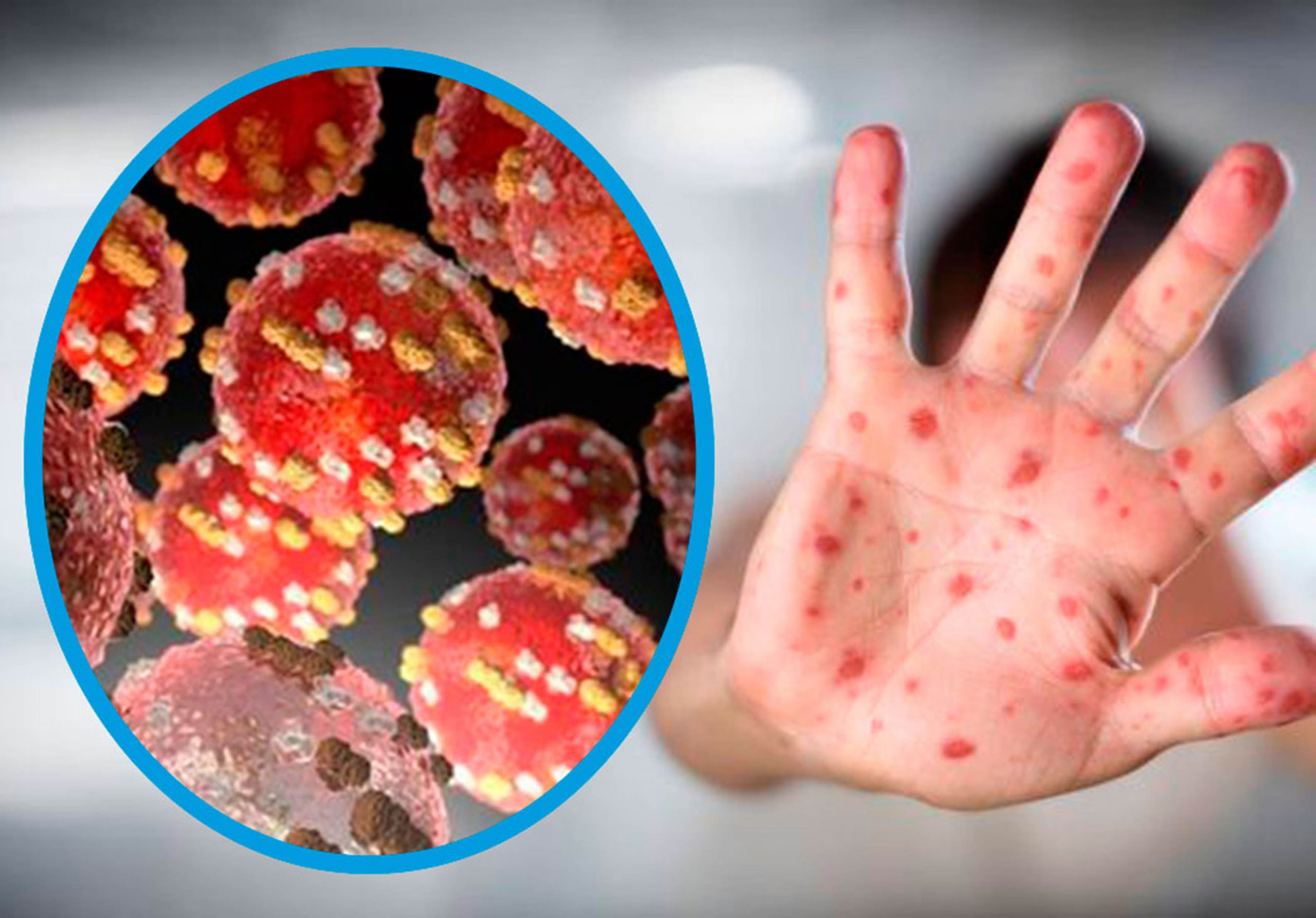 VÍDEO: Se han confirmado 60 casos de viruela del mono en 11 estados en México