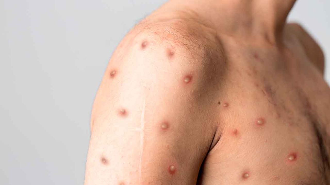 ÚLTIMA HORA: Primer caso de Viruela del Mono detectado en Oaxaca