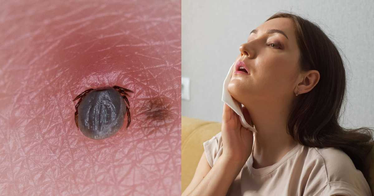 ¿Qué es la rickettsia, enfermedad causada por garrapatas y vinculada a la muerte de una menor en Nuevo León?