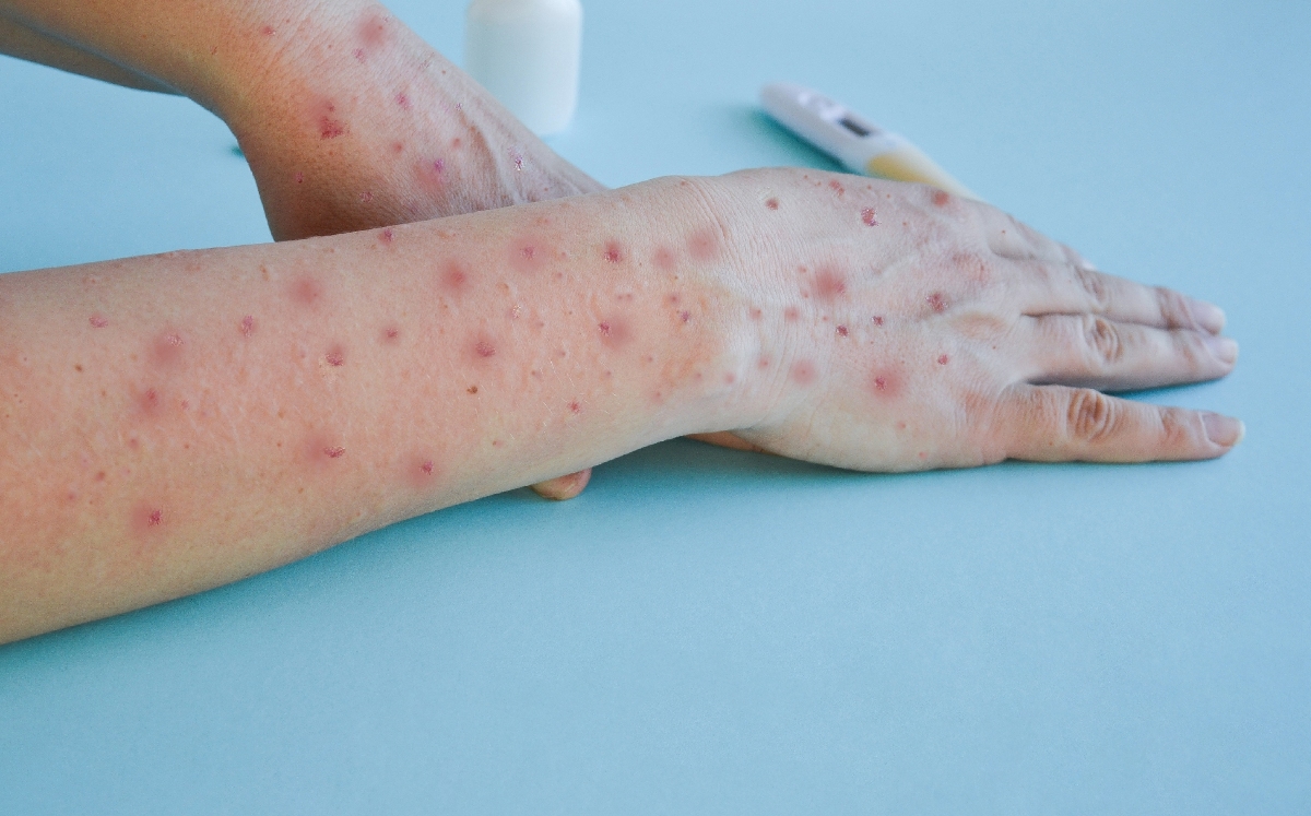 México se acerca a los 4 mil casos de la llamada viruela del mono