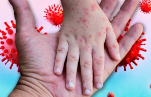 Se duplican casos de sarampión en México: 90% de los afectados no estaban vacunados