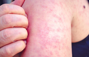 Detectan 21 casos de sarampión en México, la mayoría sin vacuna