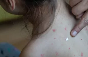 Muere niña por sarampión en Chihuahua: van cuatro fallecidos en el estado