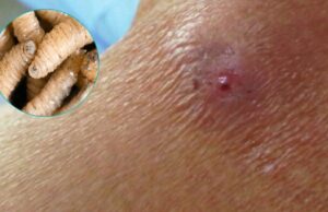 Confirman primera muerte humana por gusano barrenador en México