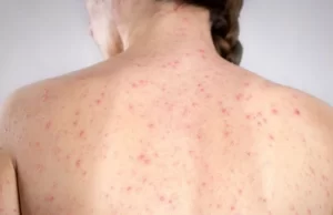 México en alerta: sarampión se dispara con 86 casos en un sólo día