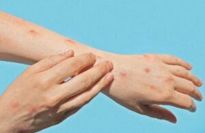 Suben a 467 los casos de viruela símica en México; CDMX concentra más de la mitad