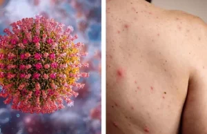 México lidera muertes por sarampión en América: van 19 fallecidos, los más afectados son niños