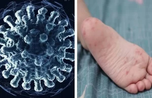 ¿Qué es el virus Coxsackie por el que se implementó un cerco sanitario en un colegio de Coahuila?