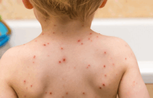 Experto alerta por rápido brote de sarampión en México; ya hay más de 5 mil casos