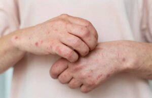 UNAM emite alerta por aumento de casos de sarampión en México: recomiendan vacunarse