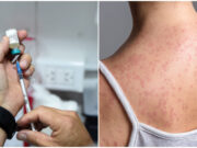 Puebla confirma primer caso de sarampión; ya hay contagios en los 32 estados