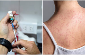 Puebla confirma primer caso de sarampión; ya hay contagios en los 32 estados