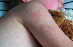 México supera los 2 mil casos de sarampión en 2026, en 36 días se dispararon contagios