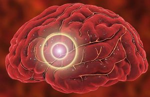 Las tasas de accidentes cerebrovasculares casi se duplican en adultos jóvenes